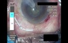 Cataract Surgery IV - Part 2