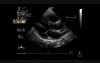Multiple Cardiac Rhabdomyoma - 2 - Follow Up - Regression