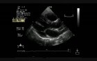 Multiple Cardiac Rhabdomyoma - 2 - Follow Up - Regression