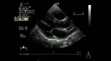 Multiple Cardiac Rhabdomyoma - 2 - Follow Up - Regression