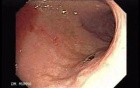 Multiple Gastric Angiodysplasia (14 of 17)