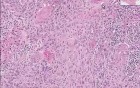 Squamous cell carcinoma - Histopathology of penis