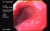 Barrett's Esophagus of long segment (2 of 24)