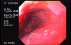 Barrett's Esophagus of long segment (2 of 24)
