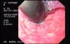 Superior Esophagic Sphincter - retroflexed view (1 of 2)