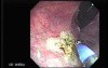 Rectal Dieulafoy’s Lesion (3 of 4)
