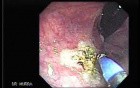 Rectal Dieulafoy’s Lesion (3 of 4)