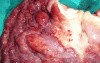 Endoscopy of Scirrhous Gastric Carcinoma involving the entire Fundus, Body and the Antrum (41 of 47)