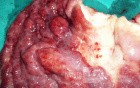 Endoscopy of Scirrhous Gastric Carcinoma involving the entire Fundus, Body and the Antrum (41 of 47)