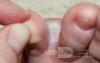 Interdigital Tinea pedis