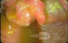 Cancer Of The Cecum