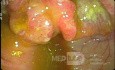 Cancer Of The Cecum