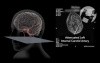 Carotid Dissection and Propagated Clot