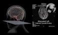 Carotid Dissection and Propagated Clot
