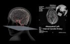 Carotid Dissection and Propagated Clot