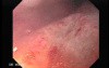 Pill Esophagitis - 4/5