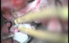 Sphenoidal Wing Meningioma - Left Pterional Approach