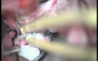 Sphenoidal Wing Meningioma - Left Pterional Approach
