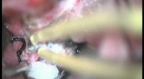 Sphenoidal Wing Meningioma - Left Pterional Approach