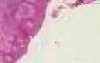 Paget disease - Histopathology - Breast