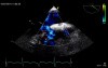 Defect of Atrial Septum - Ostium Primum