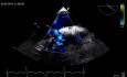 Defect of Atrial Septum - Ostium Primum