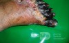 Diabetic Foot Gangrene (Forefoot) 