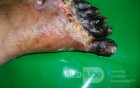 Diabetic Foot Gangrene (Forefoot) 