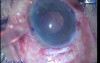 Endothelial keratoplasty- 27G bent needle