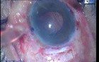 Endothelial keratoplasty- 27G bent needle