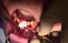 Resorbable Membrane, Mineross, and Emdogain - Extraction #24/25 with Ridge Augmentation - d-PTFE
