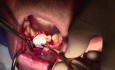 Resorbable Membrane, Mineross, and Emdogain - Extraction #24/25 with Ridge Augmentation - d-PTFE