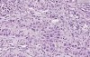Squamous cell carcinoma - Histopathology of skin