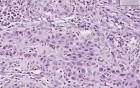 Squamous cell carcinoma - Histopathology of skin