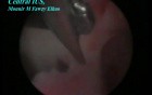 Central Intra Uterine Adhesions After Cesarean Section - Laparoscopic Treatment