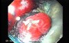 Multiple Irregular and Large Ulcers - Biopsy nr 1