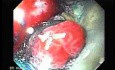 Multiple Irregular and Large Ulcers - Biopsy nr 1