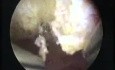 New Resection Master Systeme And Endometrial Polyp