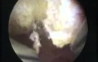 New Resection Master Systeme And Endometrial Polyp