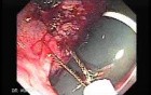 Endoscopic Resection of Giant Tubulo-Villous of the rectum (17 of 35)