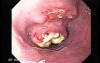 Small cell carcinoma of the lung that invades the upper and the middle third of the Esophagus (1 of 7)