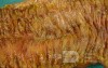 Toxic Dilatation of the Colon Superimposed pseudomembranous colitis involving the
 right colon (16 of 17)