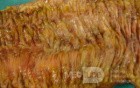 Toxic Dilatation of the Colon Superimposed pseudomembranous colitis involving the
 right colon (16 of 17)