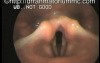 Acute Laryngitis - Voice Box