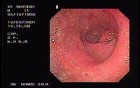 Erosive Antral Gastritis