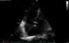Tri-Atrial Heart