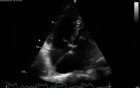 Tri-Atrial Heart