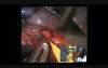 Bronchial management during uniportal left upper lobectomies