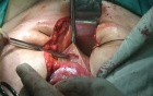 Anatomy of the Pelvis - Vesicocervical Avascular Space