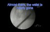 PCNL - Repeated Access/Baloon Failure